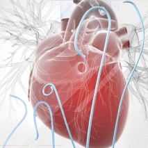 Angiographic Catheter
